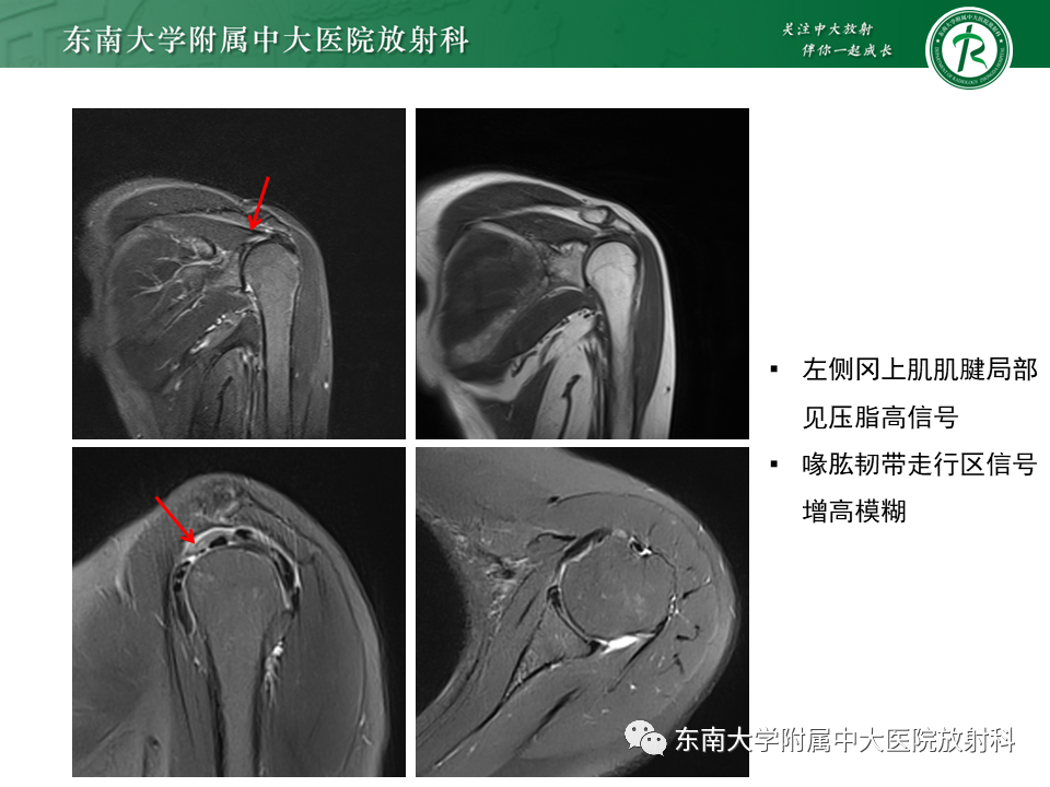 影像PPT - 【PPT】肩峰下撞击综合征-27 影像PPT - 【PPT】肩峰下撞击综合征-27