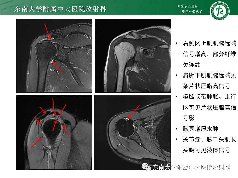 影像PPT - 【PPT】肩峰下撞击综合征-31 影像PPT - 【PPT】肩峰下撞击综合征-31