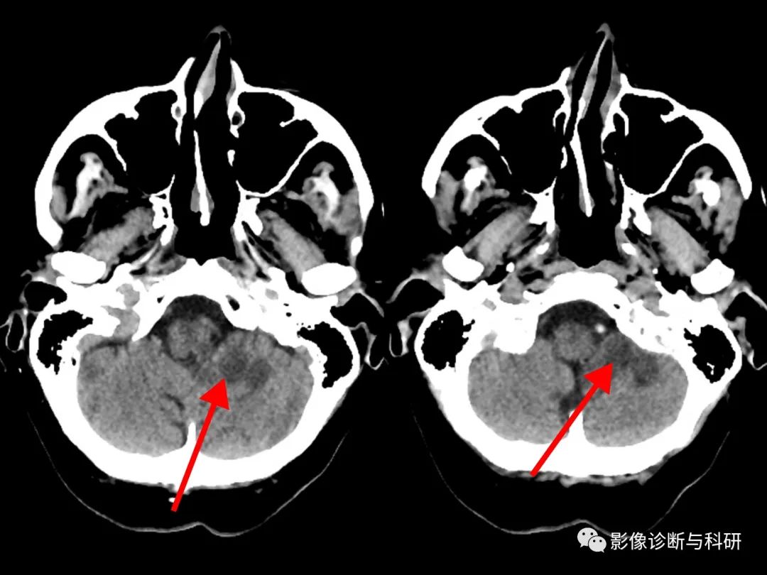 影像PPT - 小脑供血动脉及供应范围、不同分支梗塞表现-9