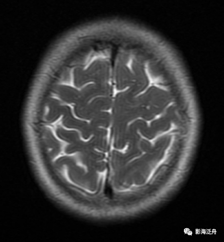影像PPT - 【病例】痛性眼肌麻痹综合征1例MR影像-1 影像PPT - 【病例】痛性眼肌麻痹综合征1例MR影像-1