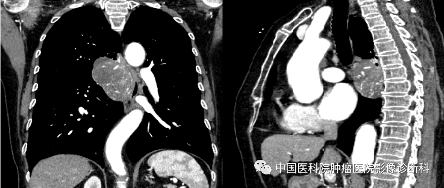 影像PPT - 【病例】后纵隔孤立性纤维瘤1例CT影像-3 影像PPT - 【病例】后纵隔孤立性纤维瘤1例CT影像-3