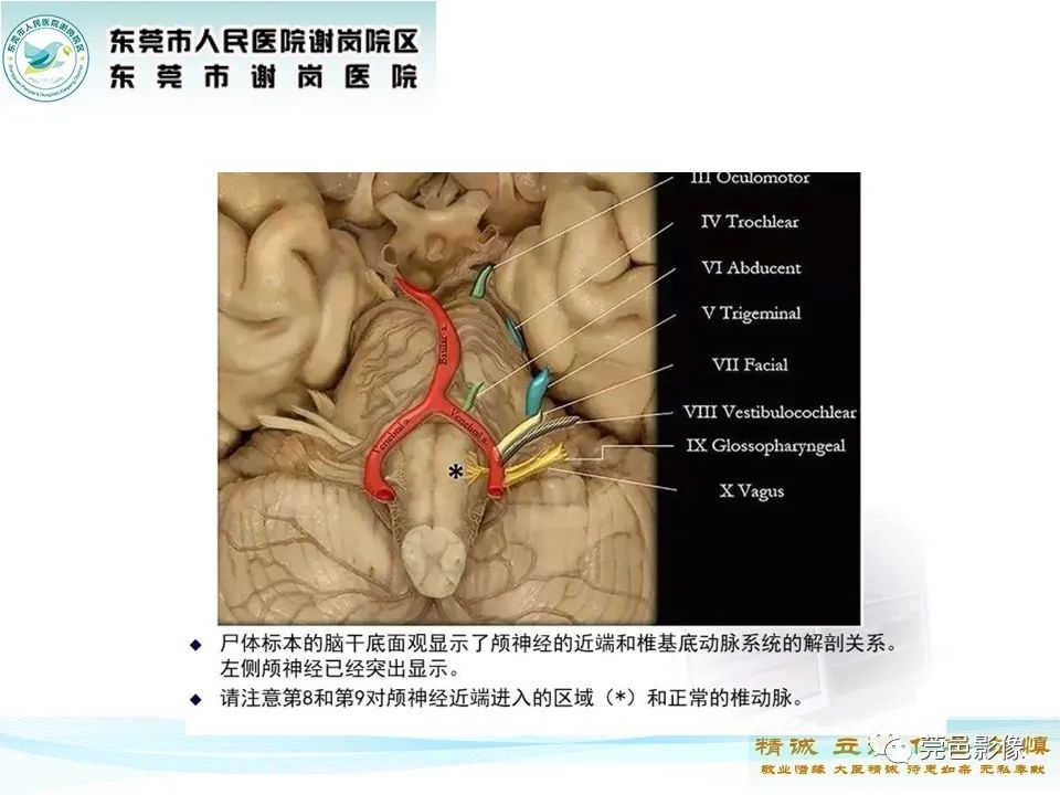 影像PPT - 【PPT】椎基底动脉延长扩张症-7
