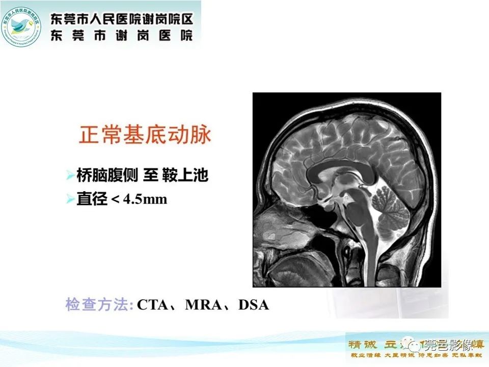 影像PPT - 【PPT】椎基底动脉延长扩张症-8