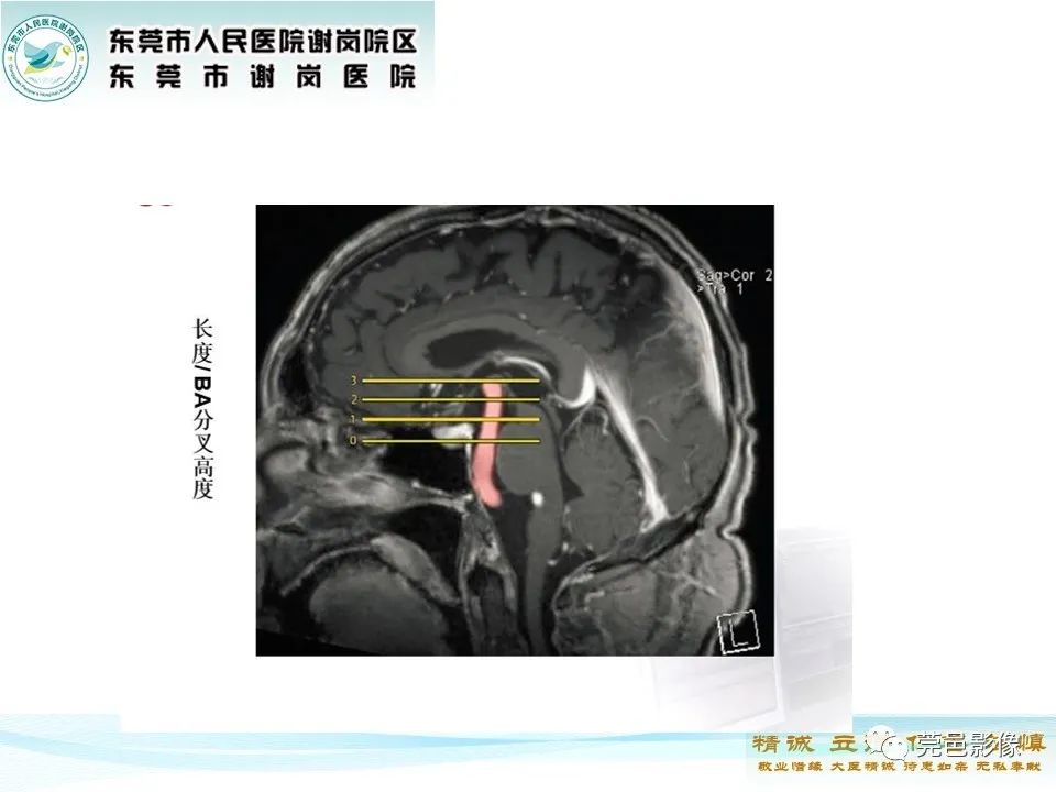 影像PPT - 【PPT】椎基底动脉延长扩张症-10
