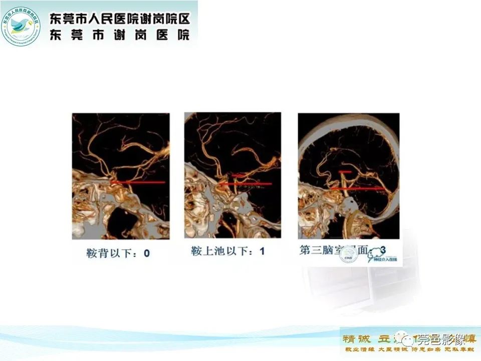 影像PPT - 【PPT】椎基底动脉延长扩张症-11