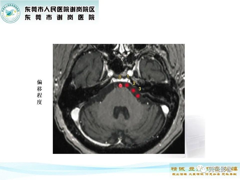 影像PPT - 【PPT】椎基底动脉延长扩张症-12