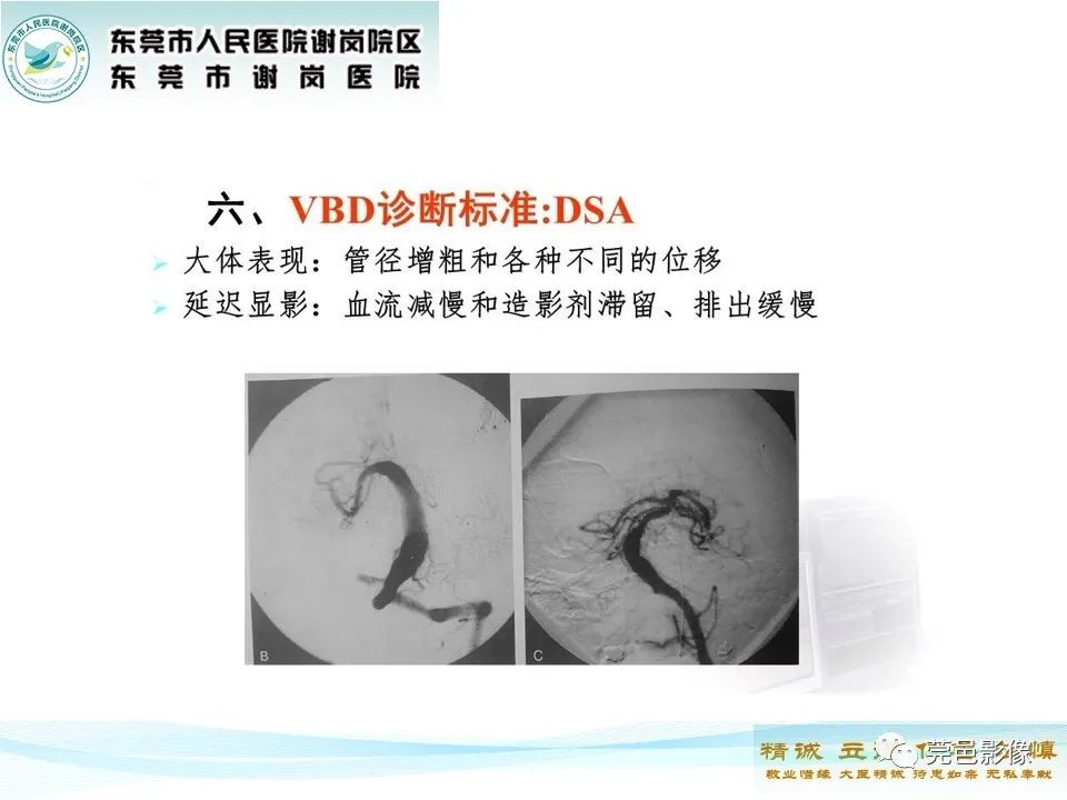 影像PPT - 【PPT】椎基底动脉延长扩张症-14