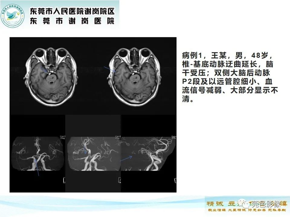 影像PPT - 【PPT】椎基底动脉延长扩张症-15