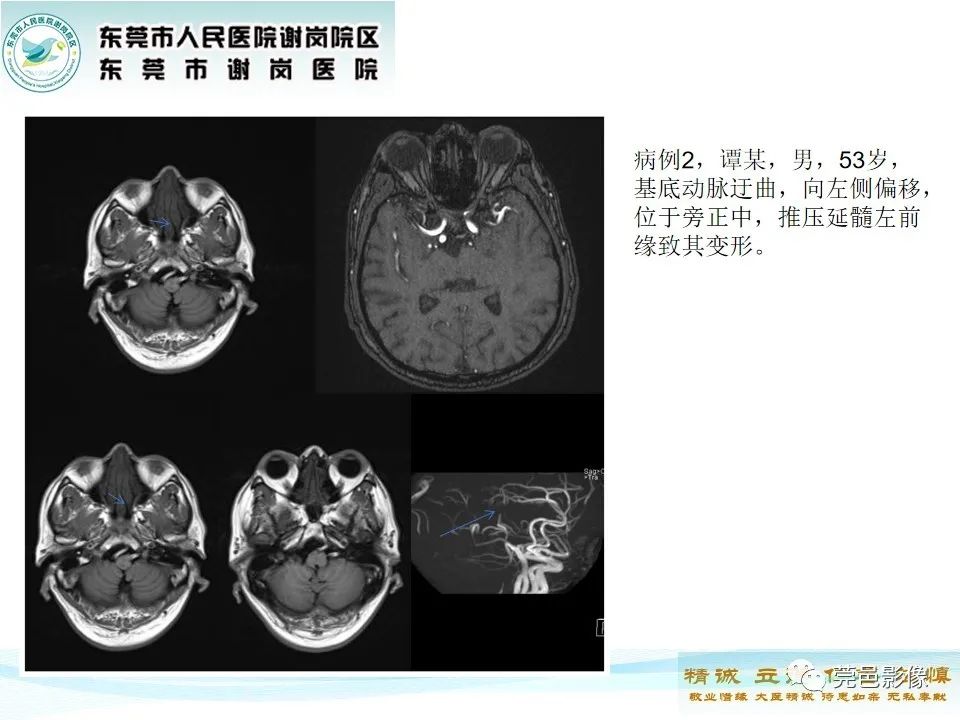 影像PPT - 【PPT】椎基底动脉延长扩张症-16