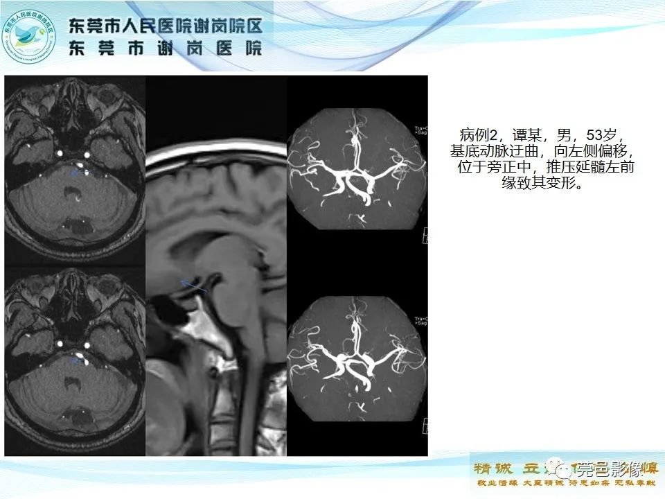 影像PPT - 【PPT】椎基底动脉延长扩张症-17