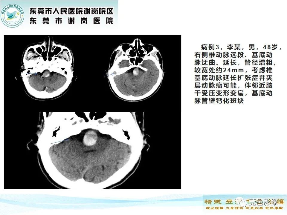 影像PPT - 【PPT】椎基底动脉延长扩张症-18