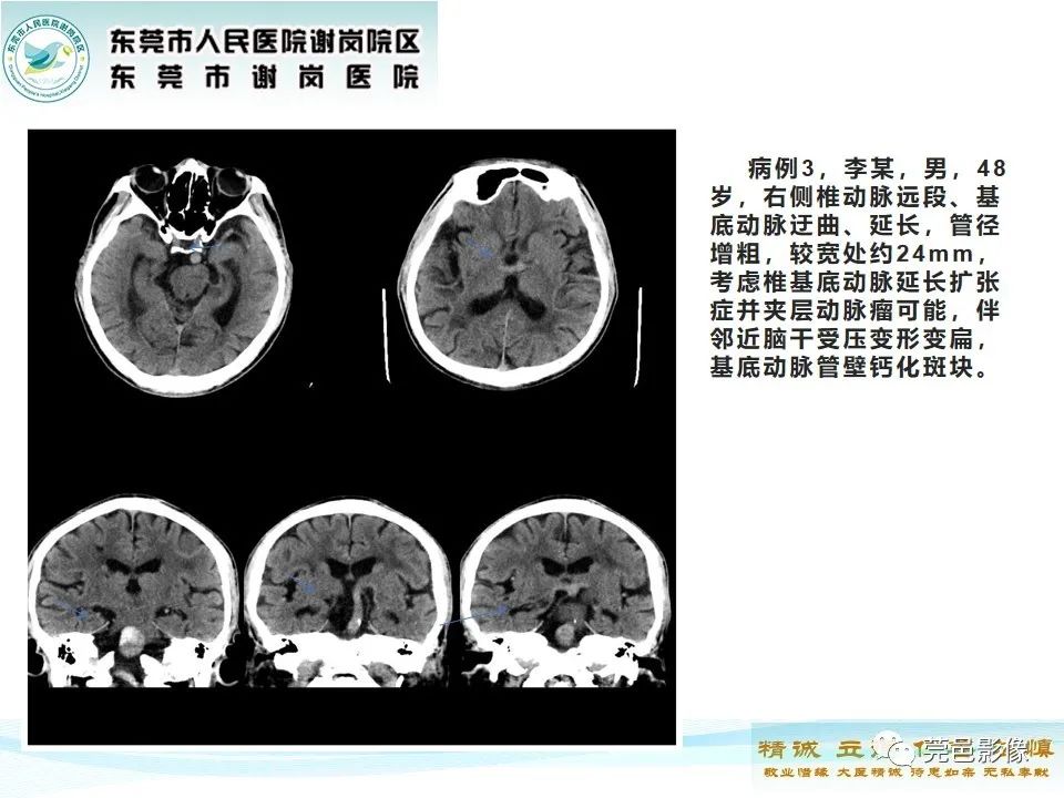影像PPT - 【PPT】椎基底动脉延长扩张症-19