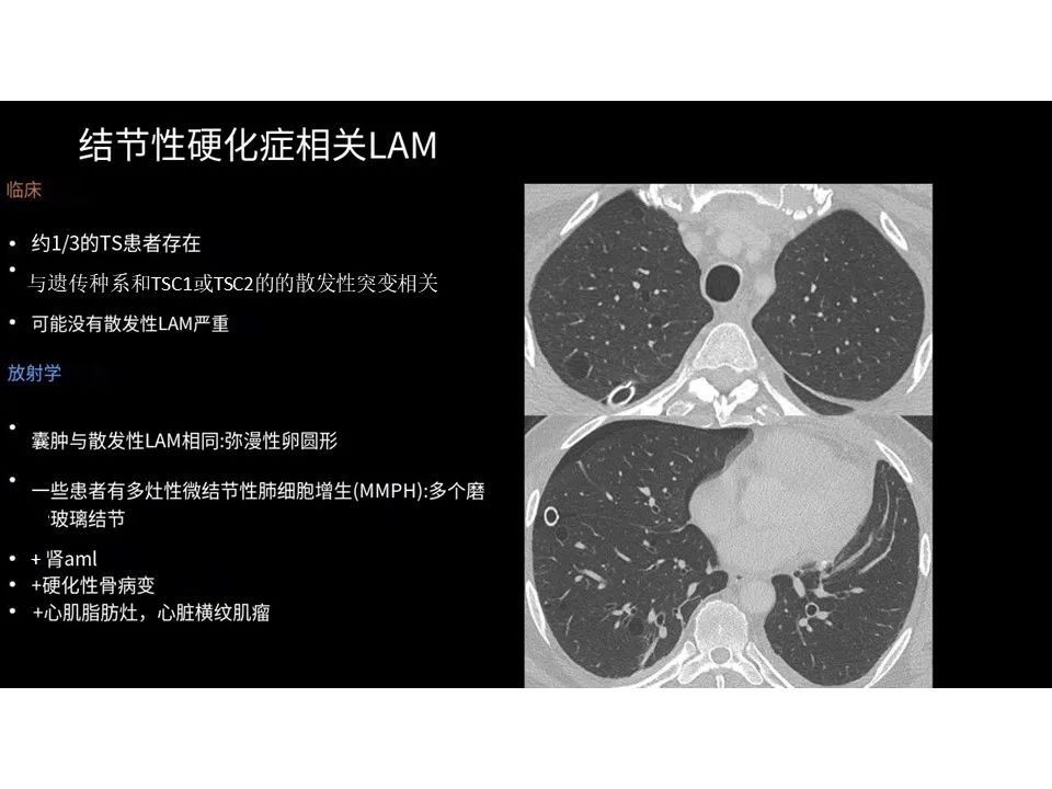 影像PPT - 【PPT】囊性肺疾病的影像学-病理相关性-7