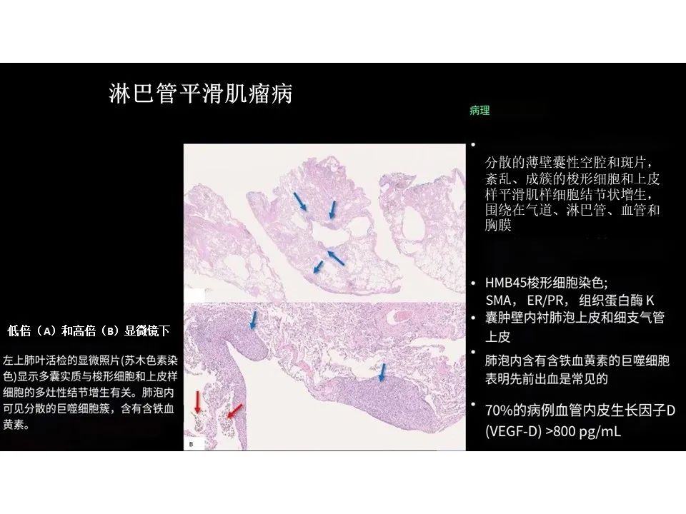 影像PPT - 【PPT】囊性肺疾病的影像学-病理相关性-6