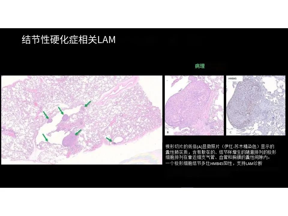 影像PPT - 【PPT】囊性肺疾病的影像学-病理相关性-8