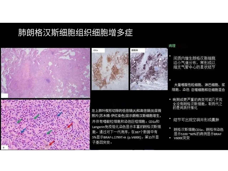 影像PPT - 【PPT】囊性肺疾病的影像学-病理相关性-10