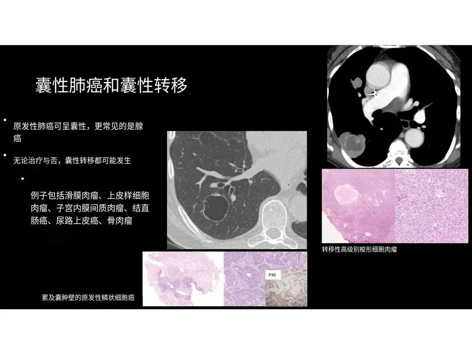 影像PPT - 【PPT】囊性肺疾病的影像学-病理相关性-11
