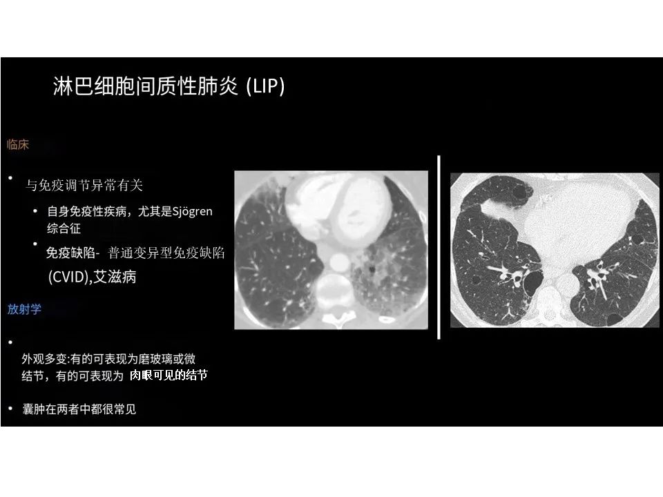 影像PPT - 【PPT】囊性肺疾病的影像学-病理相关性-13