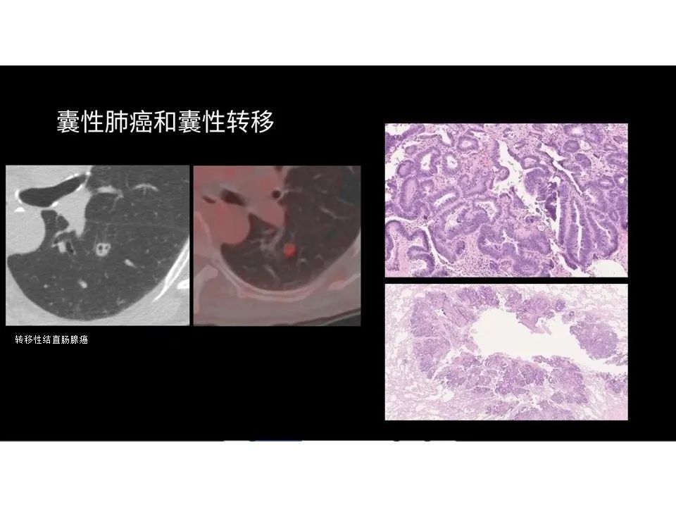 影像PPT - 【PPT】囊性肺疾病的影像学-病理相关性-12