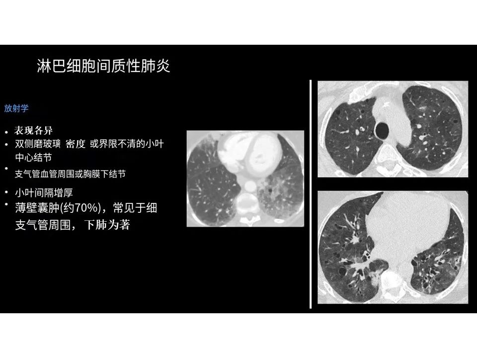 影像PPT - 【PPT】囊性肺疾病的影像学-病理相关性-14