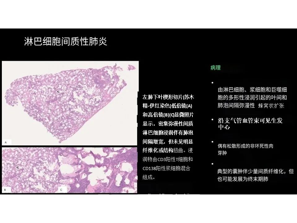 影像PPT - 【PPT】囊性肺疾病的影像学-病理相关性-15