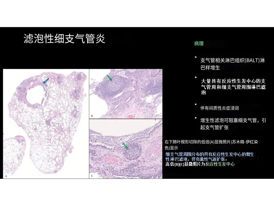 影像PPT - 【PPT】囊性肺疾病的影像学-病理相关性-17