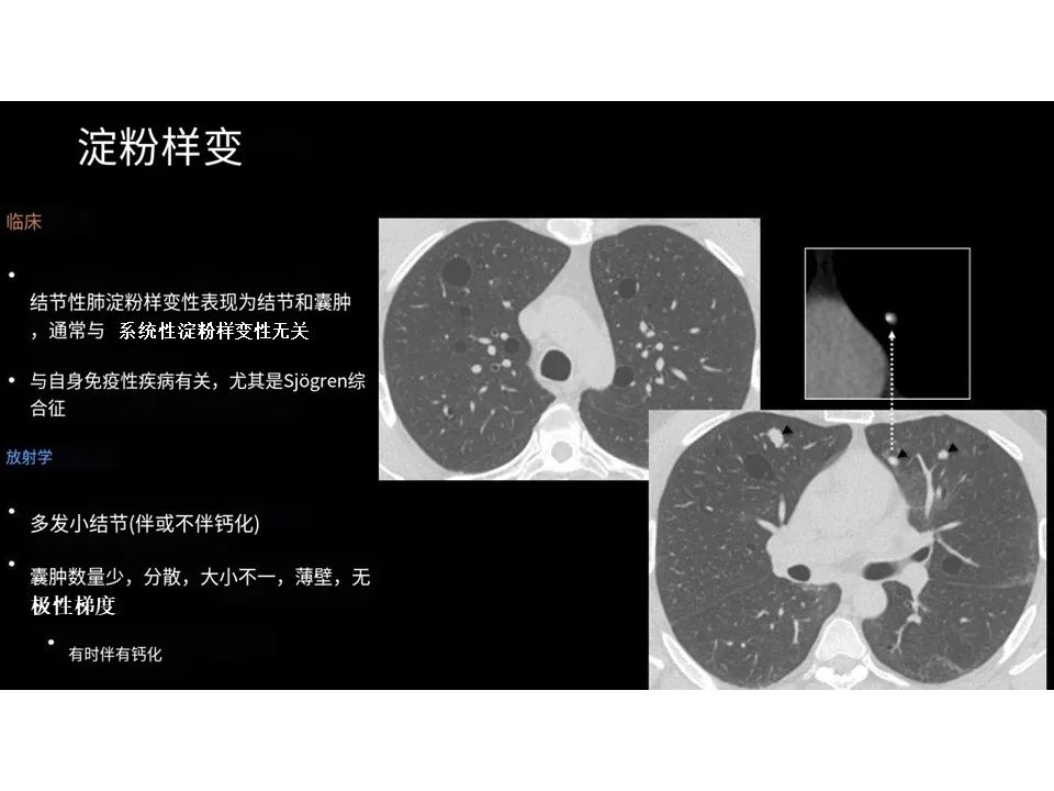 影像PPT - 【PPT】囊性肺疾病的影像学-病理相关性-18