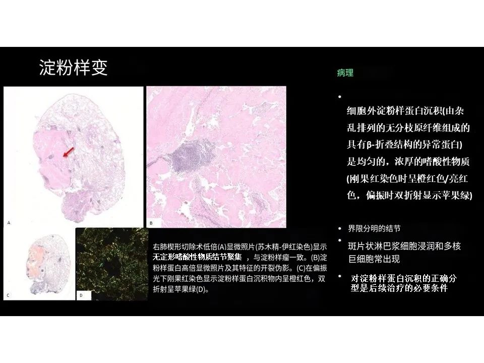 影像PPT - 【PPT】囊性肺疾病的影像学-病理相关性-19