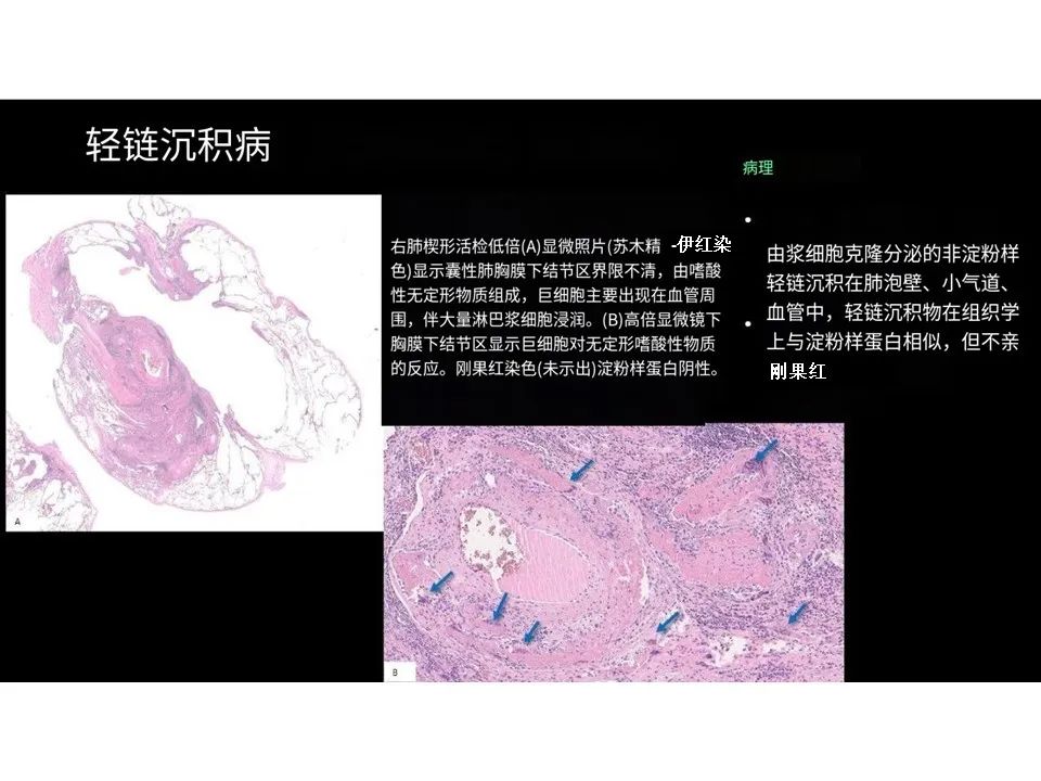 影像PPT - 【PPT】囊性肺疾病的影像学-病理相关性-21