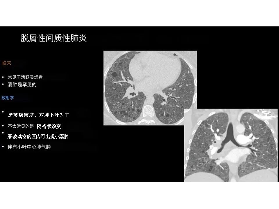 影像PPT - 【PPT】囊性肺疾病的影像学-病理相关性-22