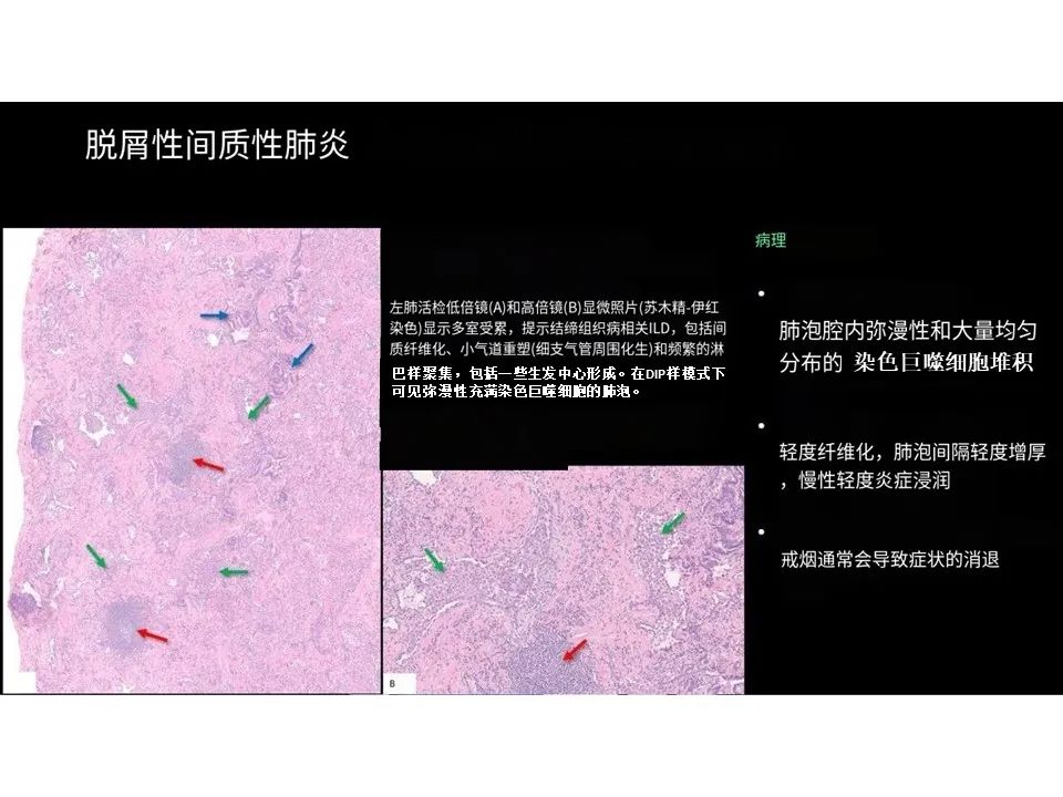 影像PPT - 【PPT】囊性肺疾病的影像学-病理相关性-23