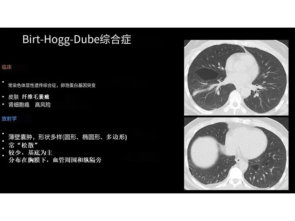 影像PPT - 【PPT】囊性肺疾病的影像学-病理相关性-24