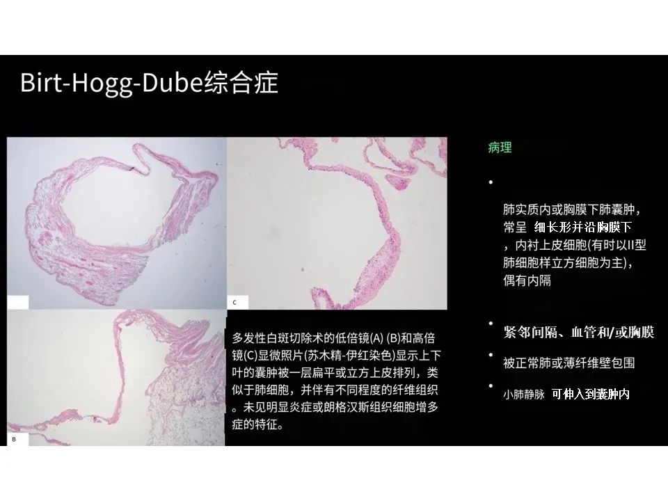 影像PPT - 【PPT】囊性肺疾病的影像学-病理相关性-25