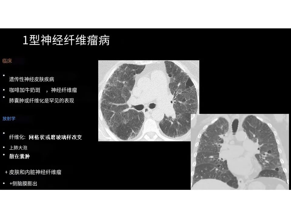影像PPT - 【PPT】囊性肺疾病的影像学-病理相关性-26