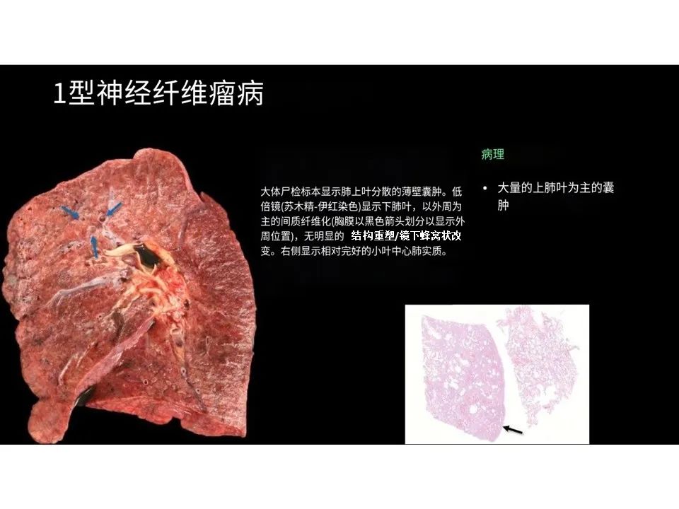 影像PPT - 【PPT】囊性肺疾病的影像学-病理相关性-27