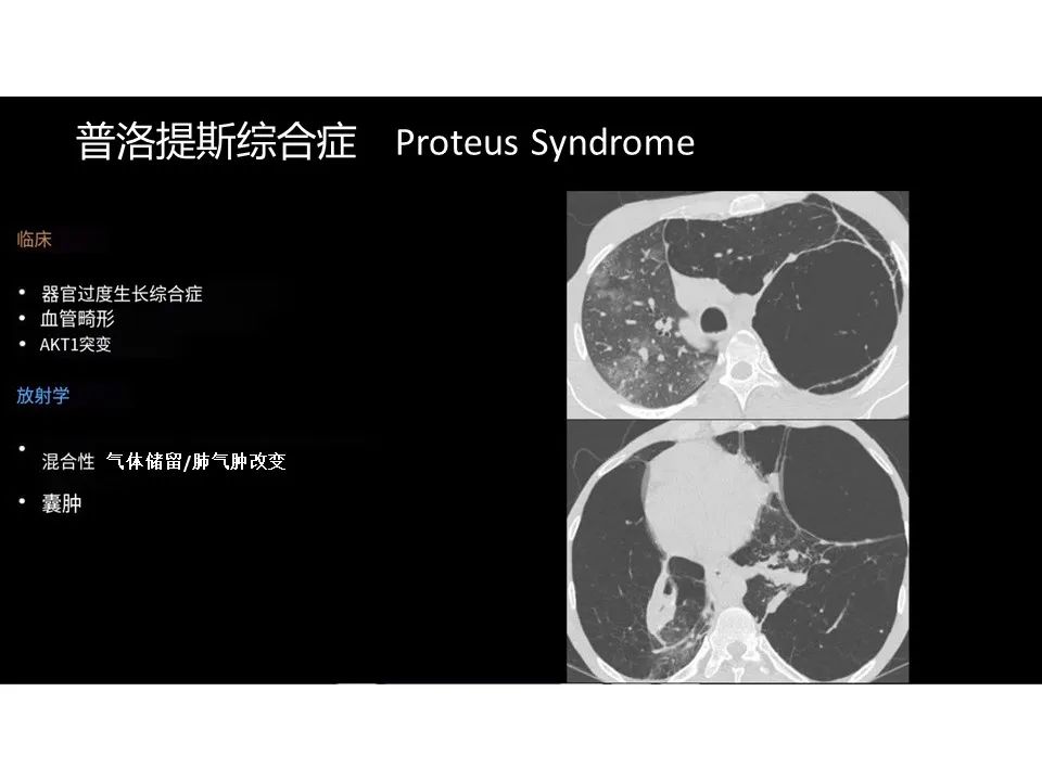 影像PPT - 【PPT】囊性肺疾病的影像学-病理相关性-28