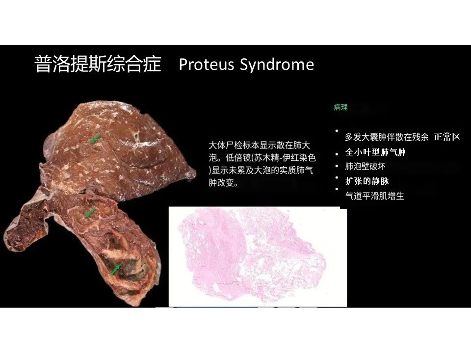 影像PPT - 【PPT】囊性肺疾病的影像学-病理相关性-29