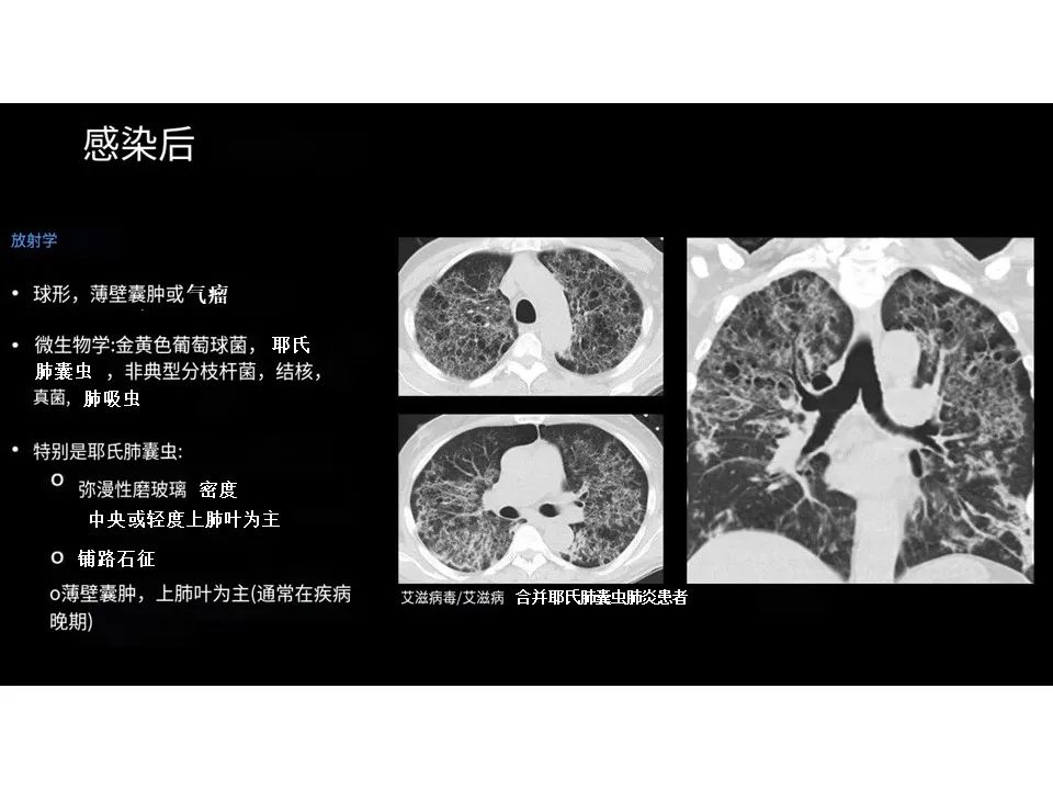 影像PPT - 【PPT】囊性肺疾病的影像学-病理相关性-30