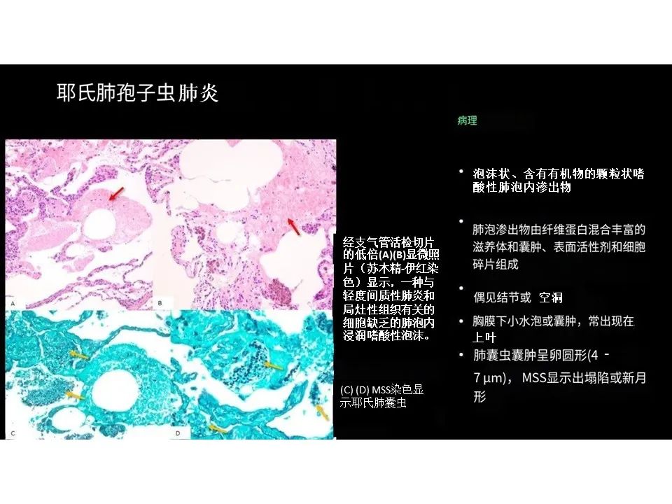 影像PPT - 【PPT】囊性肺疾病的影像学-病理相关性-31