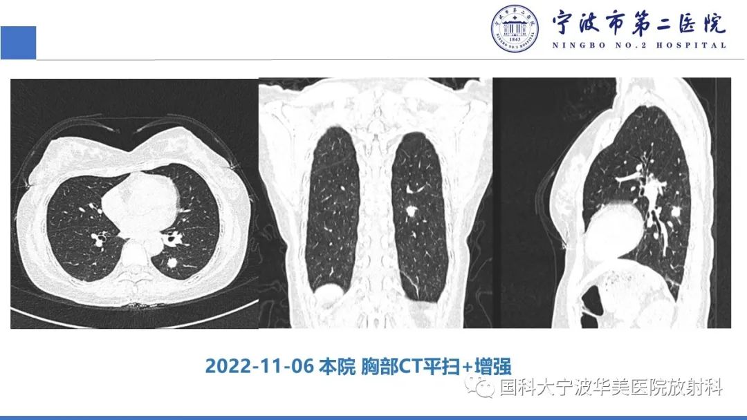 影像PPT - 【PPT】肉芽肿性肺疾病-4