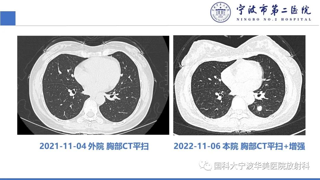 影像PPT - 【PPT】肉芽肿性肺疾病-3