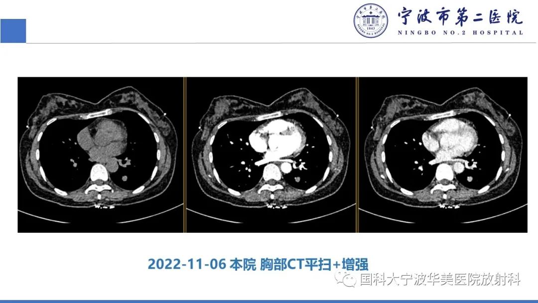 影像PPT - 【PPT】肉芽肿性肺疾病-5