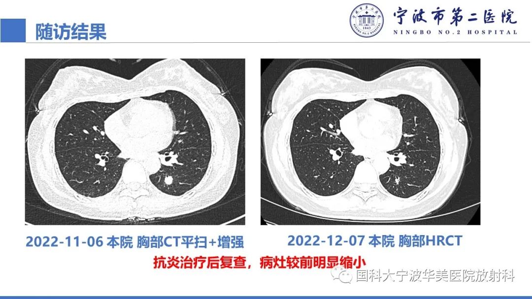 影像PPT - 【PPT】肉芽肿性肺疾病-11