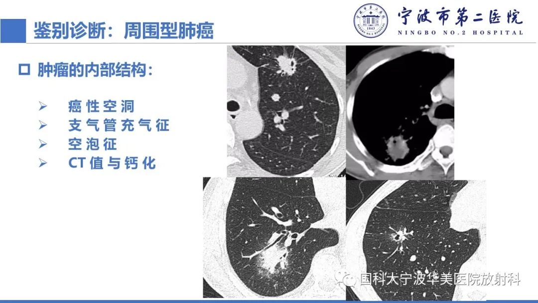 影像PPT - 【PPT】肉芽肿性肺疾病-17