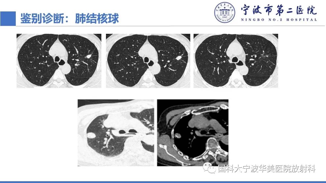 影像PPT - 【PPT】肉芽肿性肺疾病-20
