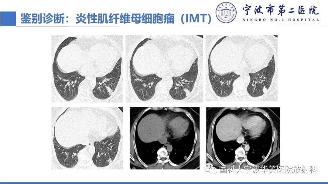 影像PPT - 【PPT】肉芽肿性肺疾病-22