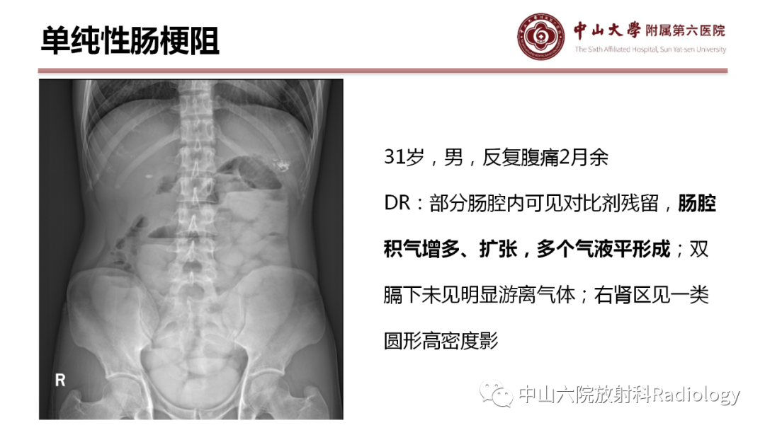 影像PPT - 【PPT】肠梗阻影像学表现与常见病因-5