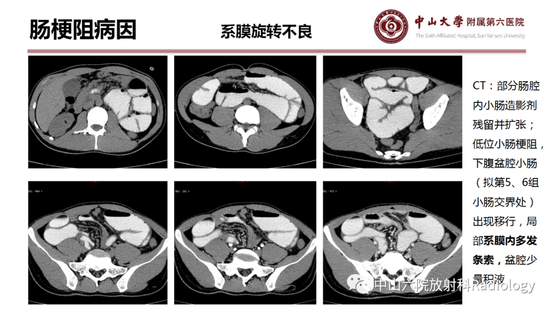 影像PPT - 【PPT】肠梗阻影像学表现与常见病因-6