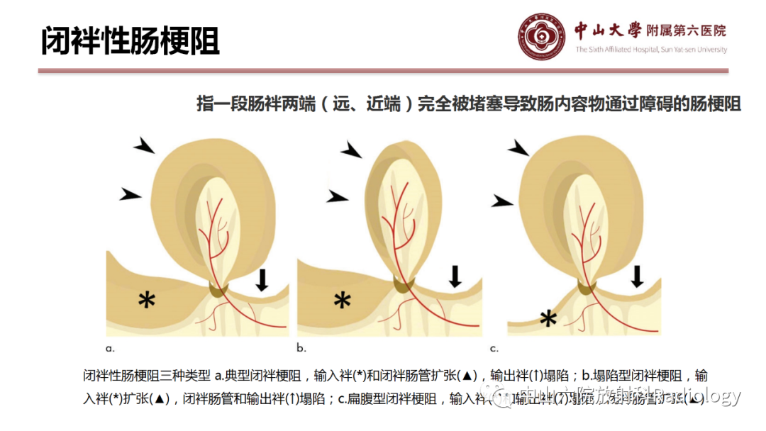 影像PPT - 【PPT】肠梗阻影像学表现与常见病因-7