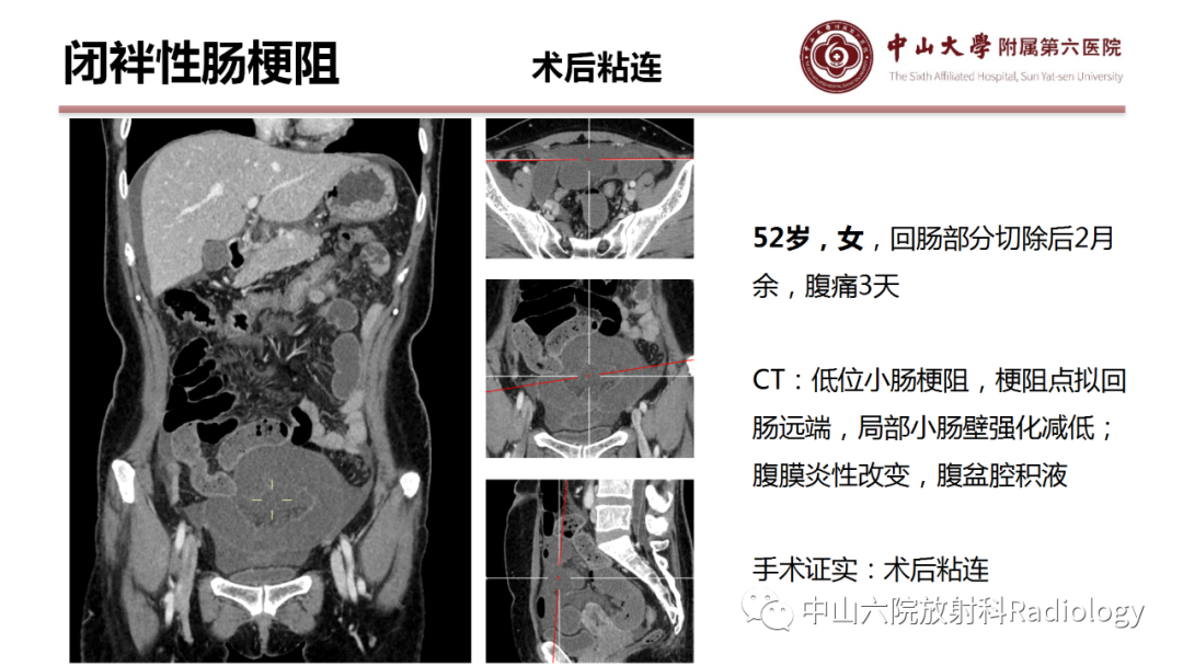影像PPT - 【PPT】肠梗阻影像学表现与常见病因-8